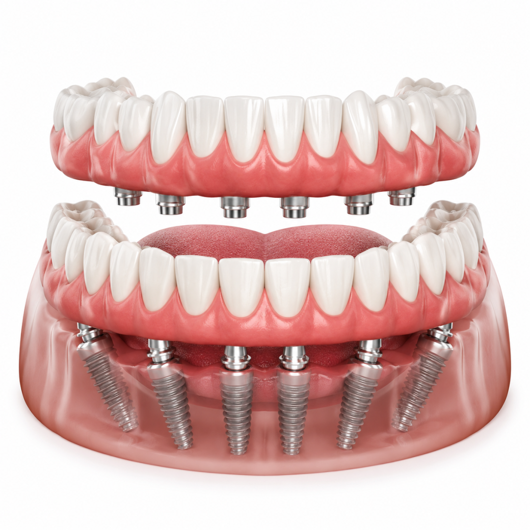 Full nmouth Implant treatment in akola